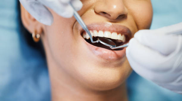 Best Emergency Dentist for Lost Fillings or Crowns in West Jefferson, NC